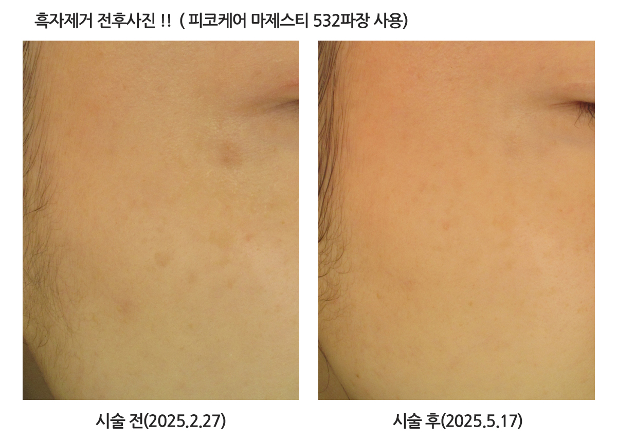 피코케어 마제스티 상세 안내 이미지 1